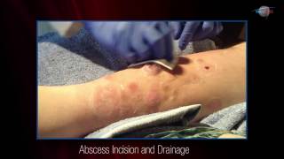 WCW Abscess Incision and Drainage [upl. by Aelaza776]