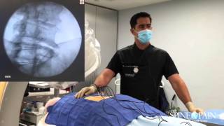 Radiofrequency Ablation Procedure [upl. by Weisbrodt]