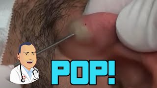 Penbrooks Ear Cyst Gets Popped [upl. by Marras]