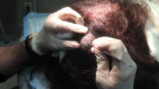 Pilar Cyst Removal on the Scalp [upl. by Kendall]