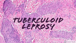 Tuberculoid Leprosy Hansen disease 5Minute Pathology Pearls Dermatology Dermatopathology [upl. by Ahtabat]