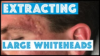 Acne Vulgaris and Extracting large Whiteheads  Part 1 [upl. by Toh]