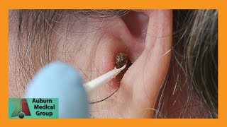 Chunky Earwax Removal  Auburn Medical Group [upl. by Asiilanna]