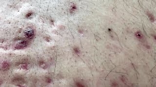 How To Remove Blackheads And Whiteheads On Back ✦ Dr Laelia ✦ [upl. by Schaaff]