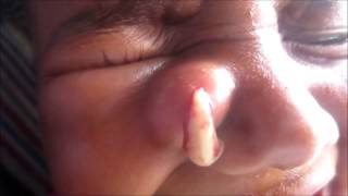 Abscess On Side Of Nose [upl. by Leeke406]