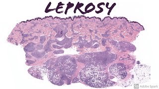 Lepromatous Leprosy Hansen Disease 5Minute Pathology Pearls [upl. by Einnaoj]