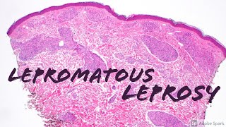 Lepromatous Leprosy 5Minute Pathology Pearls Dermatology Dermatopathology [upl. by Leifer85]