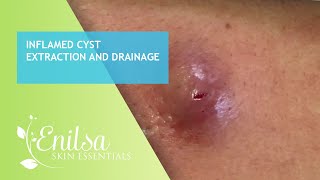 Inflamed Cyst Extraction and Drainage [upl. by Bevash]